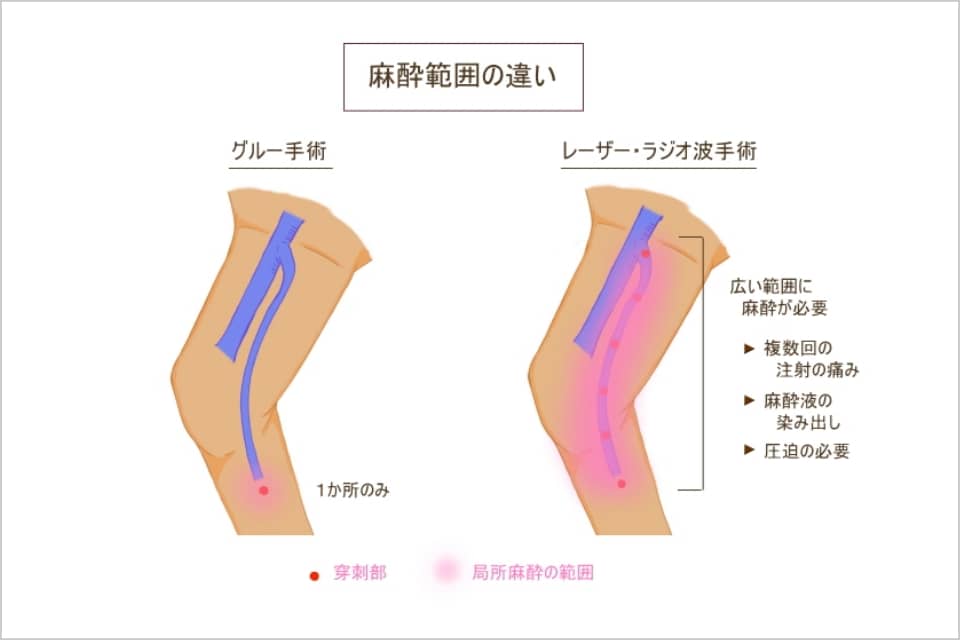 グルー手術とレーザー・ラジオ波手術の麻酔範囲の違い