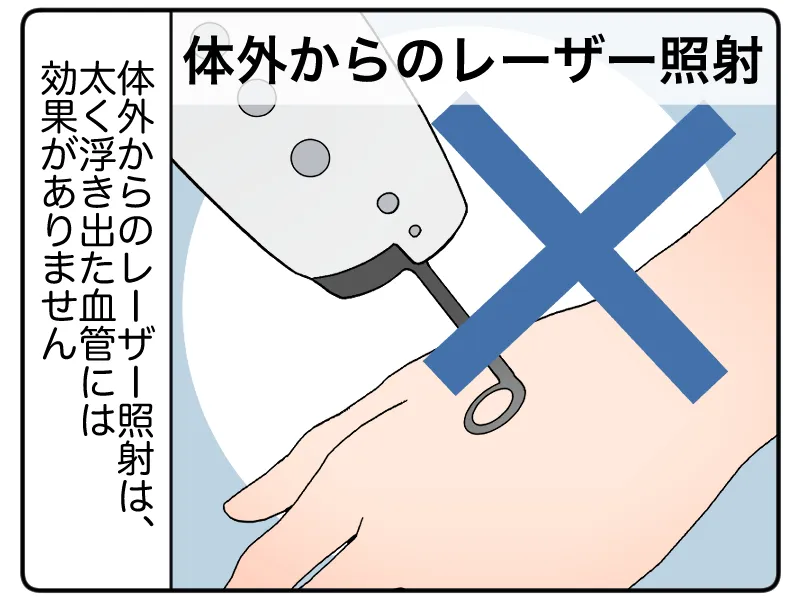 「体外からのレーザー照射:体外からのレーザー照射は、太く浮き出た血管には効果がありません」