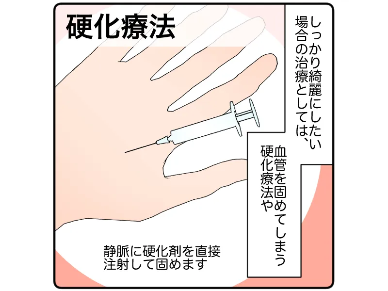「硬化療法:静脈に硬化剤を直接注射して固めます」「しっかり綺麗にしたい場合の治療としては、血管を固めてしまう硬化療法や」