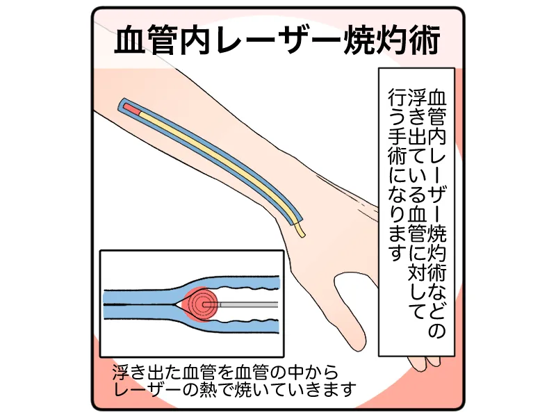 「血管内焼灼術:浮き出た血管を血管の中からレーザーの熱で焼いていきます」「血管内レーザー焼灼術などの浮き出ている血管に対して行う手術になります」