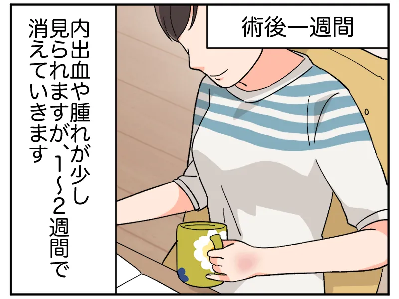 術後1週間「内出血や腫れが少し見られますが、1~2週間で消えていきます」