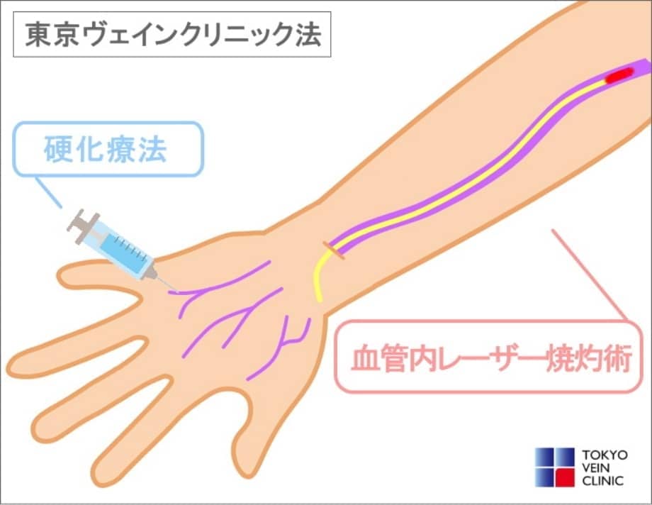 ハンドベイン硬化療法とレーザー手術を組み合わせた東京ヴェインクリニック法の説明