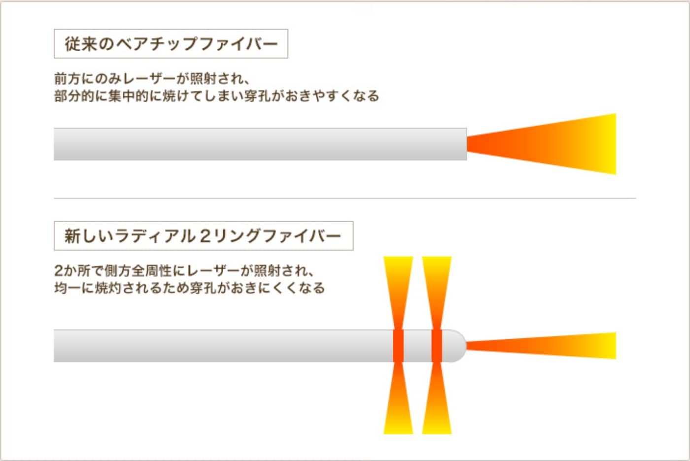 従来のベアチップファイバーとラディアル2リングファイバーの照射の違い