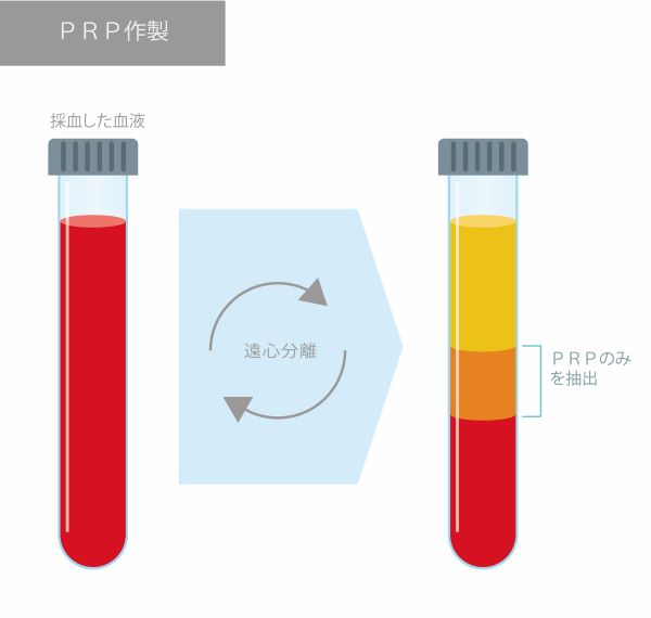 PRP（多血小板血漿）の作り方