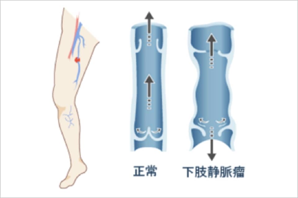 下肢静脈瘤が出来てしまう仕組みの説明