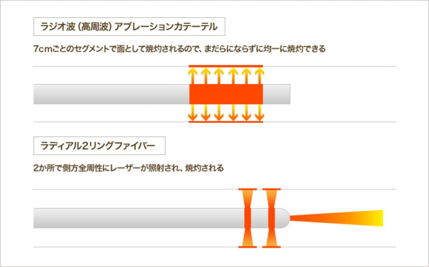 ラジオ波のアブレーションカテーテルとレーザーのラディアル２リングファイバーとの違い