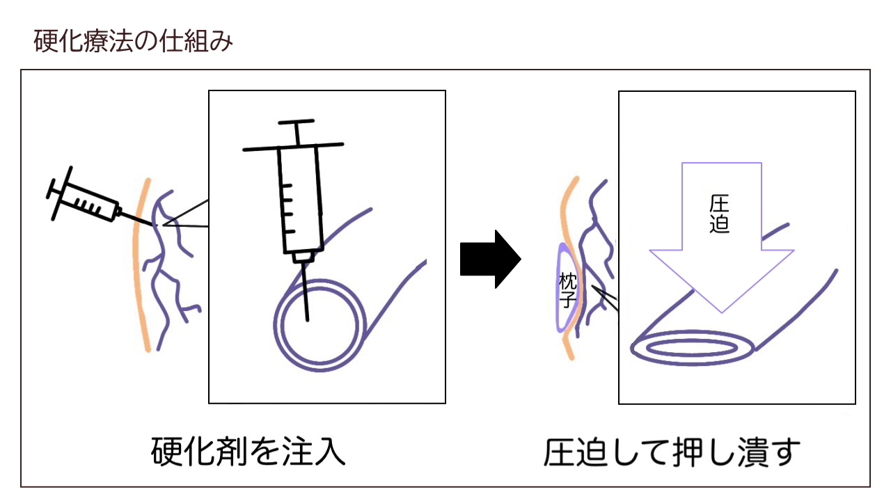 硬化 療法 と は