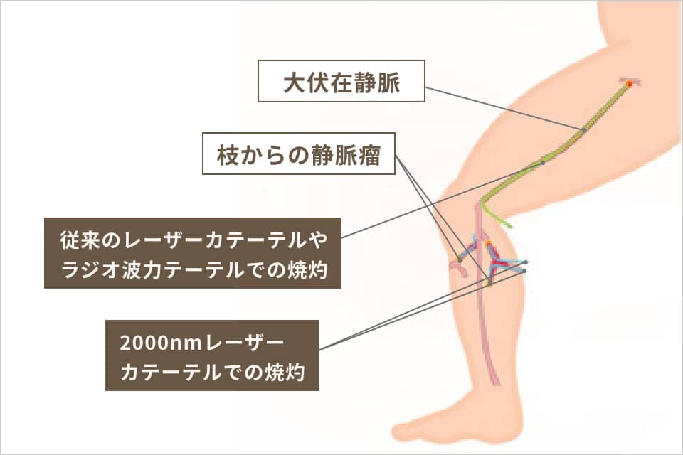 TVCメソッドの手術方法の説明イラスト