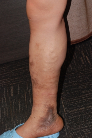 下肢静脈瘤の手術前の画像10、伏在型静脈瘤、色素沈着、皮膚潰瘍、皮膚炎、皮膚硬化あり、