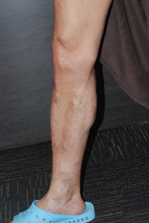 下肢静脈瘤の手術前の画像16、伏在型静脈瘤、かゆみ、皮膚炎あり。