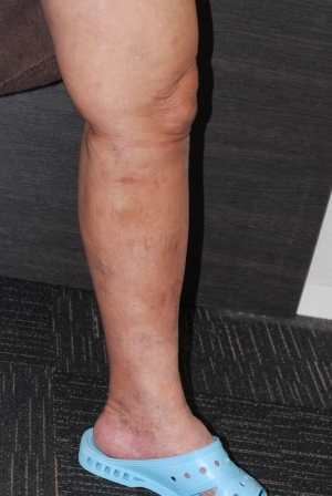 下肢静脈瘤のレーザー手術（ＴＶＣメソッド）１か月後の画像20