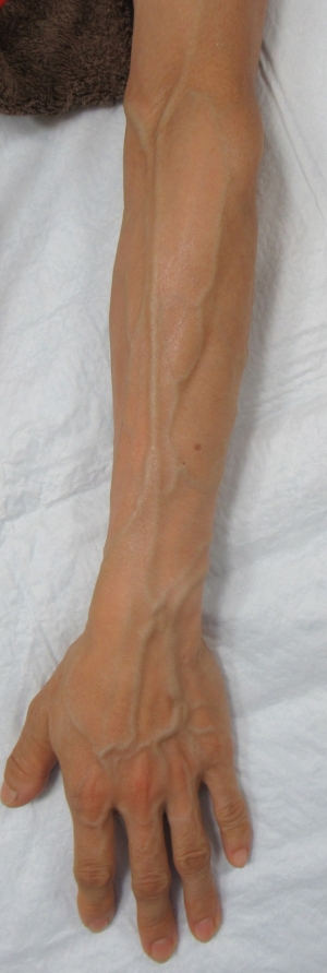 ハンドベインの手術前の画像1、腕と手の甲の血管拡張