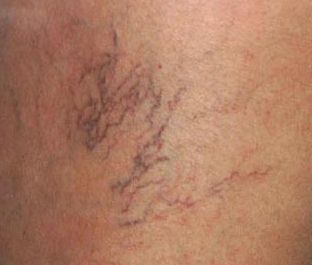 くもの巣状静脈瘤の画像